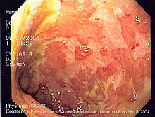 Picture of Ulcerative Colitis Left Side Colon