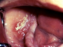 Picture of thrush in HIV/AIDS patient is infected with secondary acute oral candidiasis
