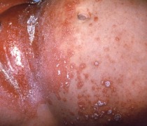 picture of infant with Candidiasis rash