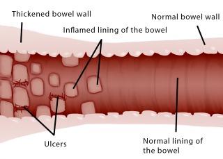 picture of Crohn's disease in bowel