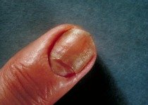 picture of fingernail infection
